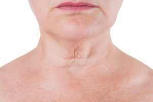 neck-lift-sagging-neck